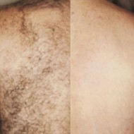 Candela Hair Laser Removal